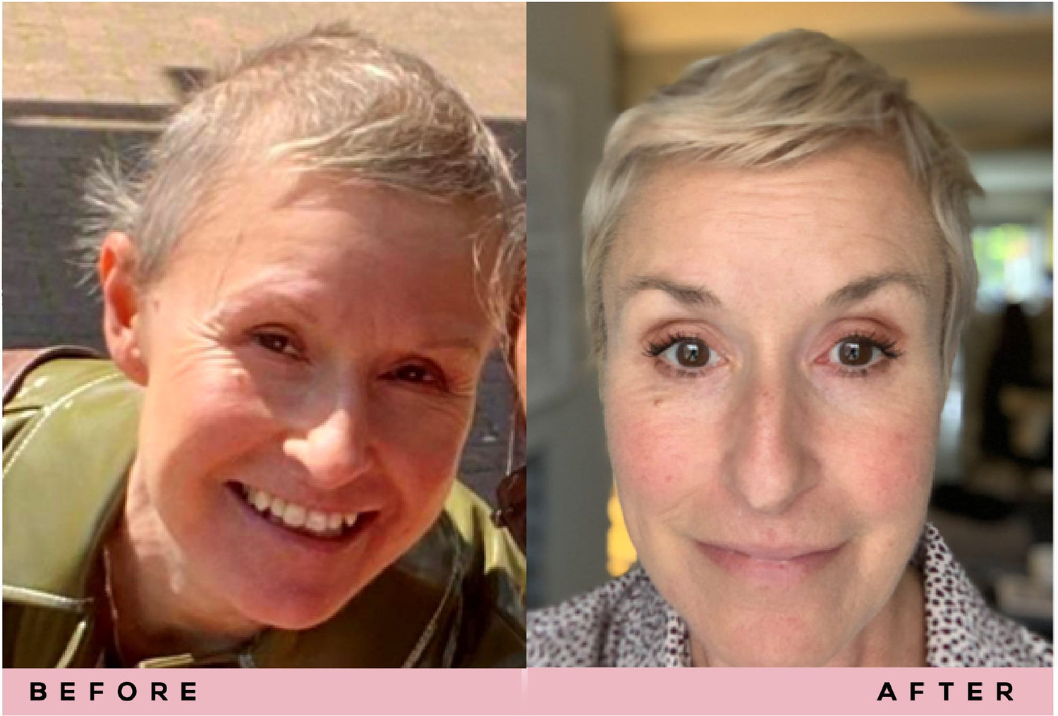 Breast cancer survivor